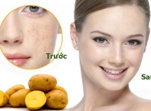Bất ngờ với cách chữa nám da bằng khoai tây hết nám sau 3 ngày